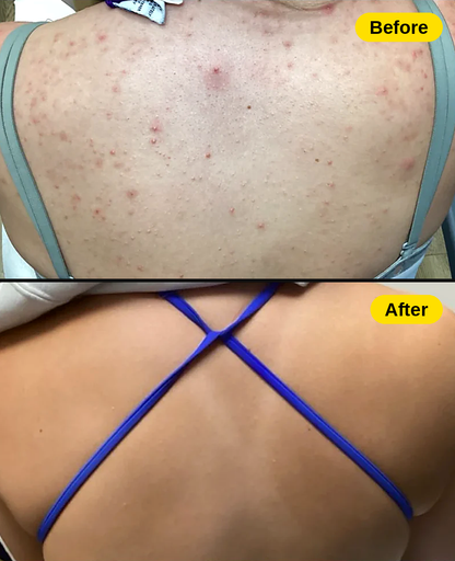 Clearback No Acne Bar — Back &amp; Body Acne Soap
