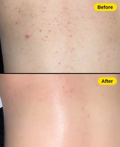 Clearback No Acne Bar — Back &amp; Body Acne Soap